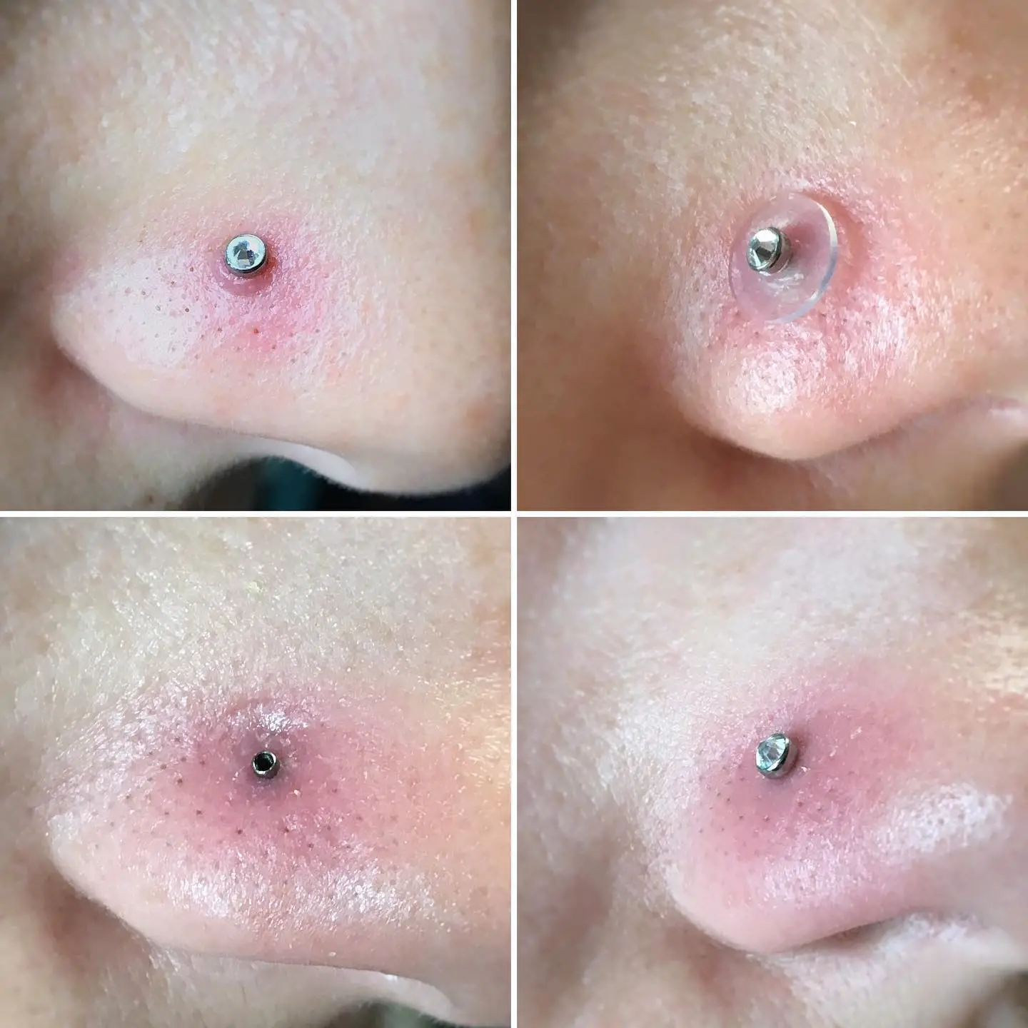 How To Heal Piercing Bumps With Aspirin Paste?